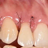 Puntos de sutura en periodoncia